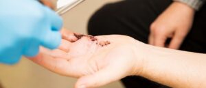 What Do You Have to do After Carpal Tunnel Surgery?